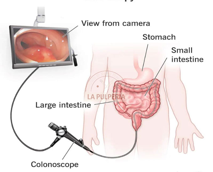 What is a Colonoscopy